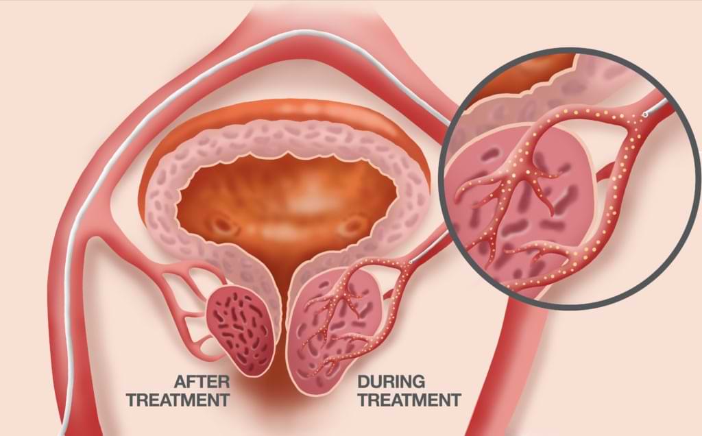 prostate artery embolization diagram